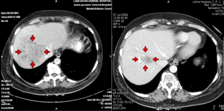 Liver tumour