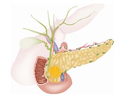 Pancreatic Cancer